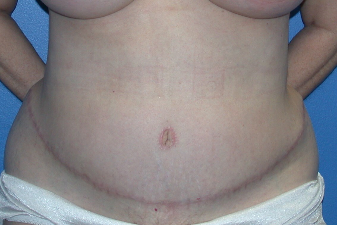 Abdominoplasty tummy tuck After full abdominoplasty