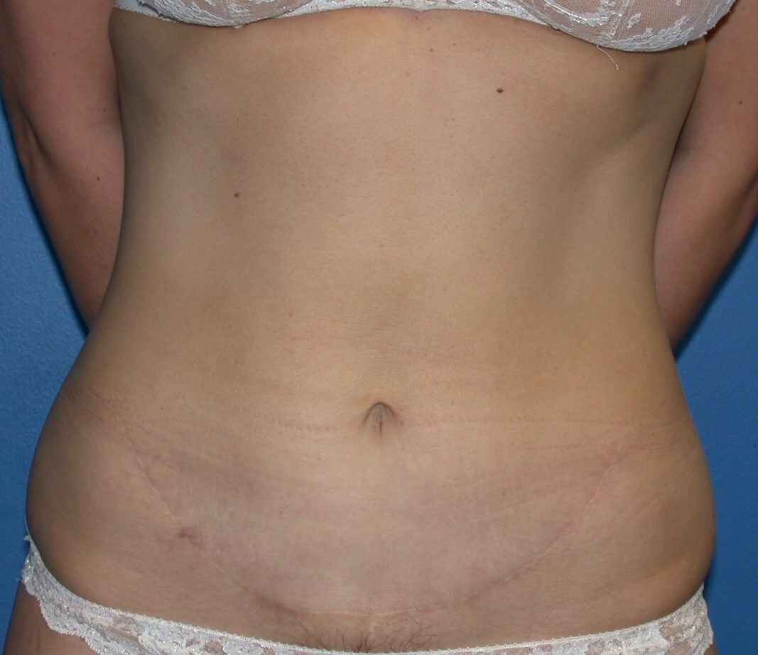 Mini abdominoplasty tummy tuck After mini-abdominoplasty