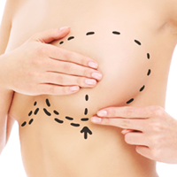 Breast ReSensation® Surgery in Houston, TX